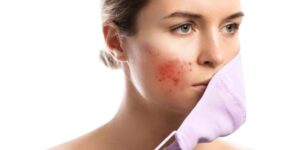 Acne treatment in Vikaspuri by Dr. Manoj Jain Vardhman Skin Clinic