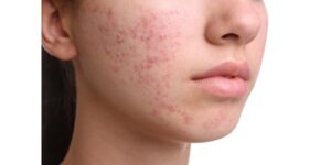 Acne causes and skin treatment West Delhi dermatologist