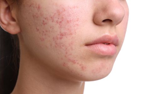 Acne treatment in Vikaspuri by Dr. Manoj Jain Vardhman Skin Clinic