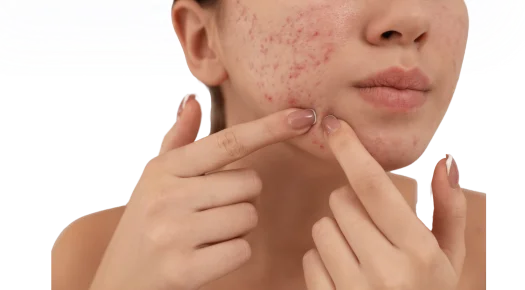 Acne treatment in Vikaspuri by Dr. Manoj Jain